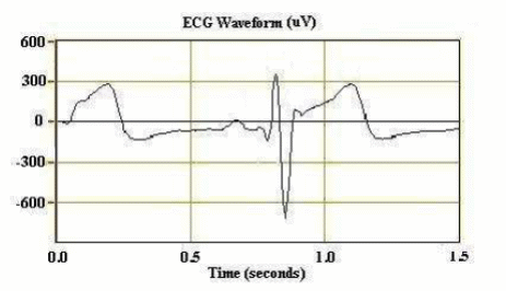 Figura 3 – sinal ECG do batimento cardíaco
